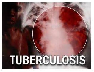Tuberkulose Tuberkulose