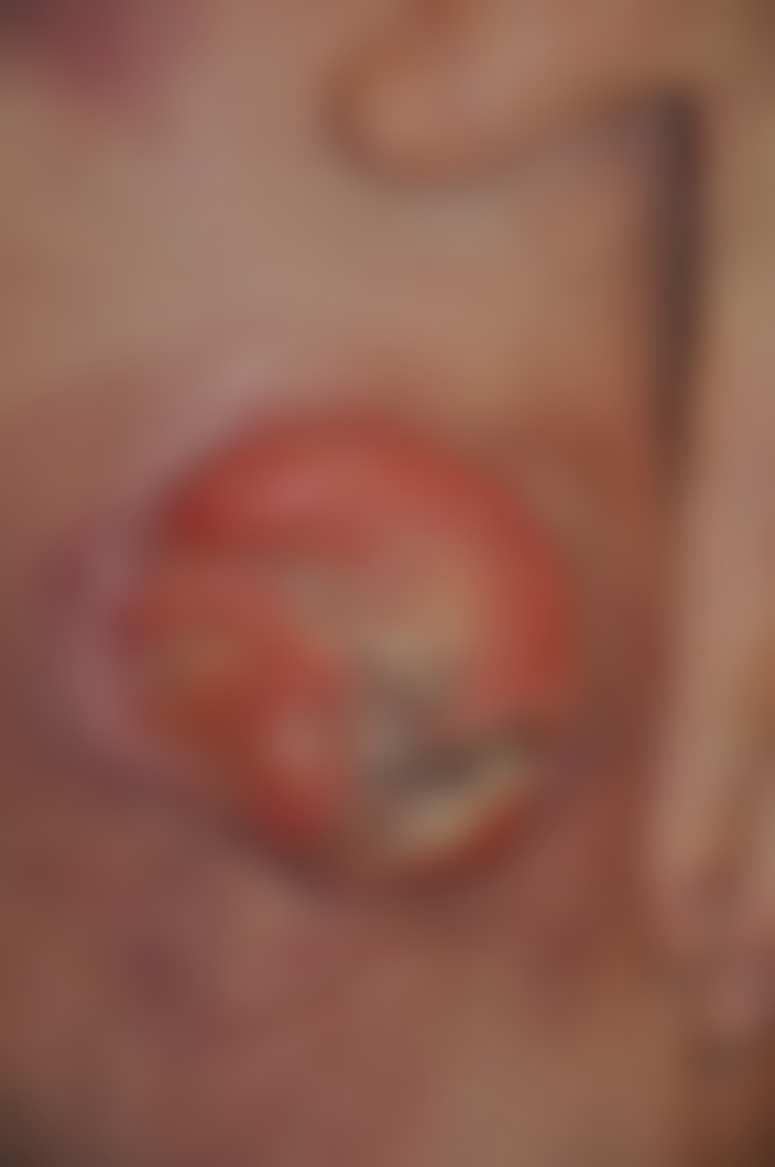 De største svulstene var enda større en denne og store som hamburgere.