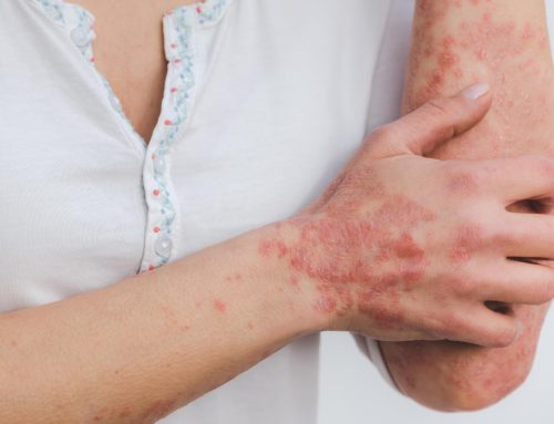 Kan kosthold hjelpe mot psoriasis?